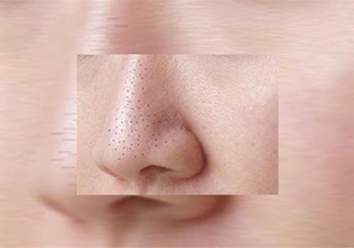 محو جوش های سرسیاه